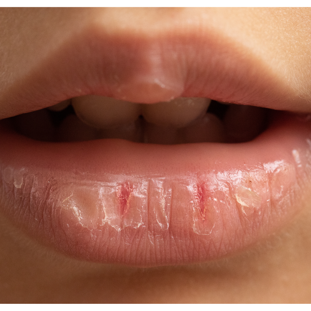 Kiss Those Chapped Lips Goodbye: A Guide to Tackling Dry Lips in Kids