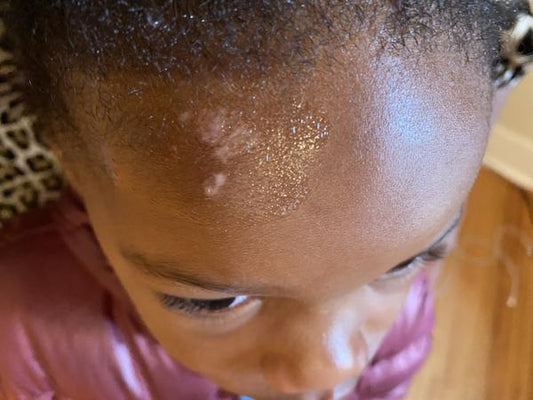 What is Hyperpigmentation and How to Get Rid of it?