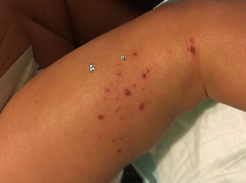 Eczema and Atopic Dermatitis in Children of Color