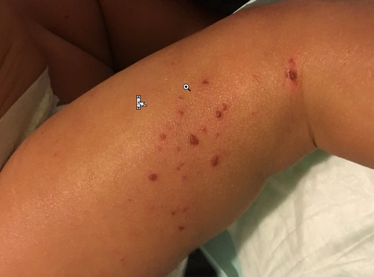Eczema and Atopic Dermatitis in Children of Color